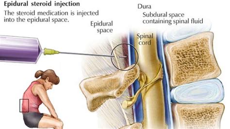 Seek emergency medical care if you experience changes in your thinking, fever, worsening neck pain,. . Epidural steroid injection side effects